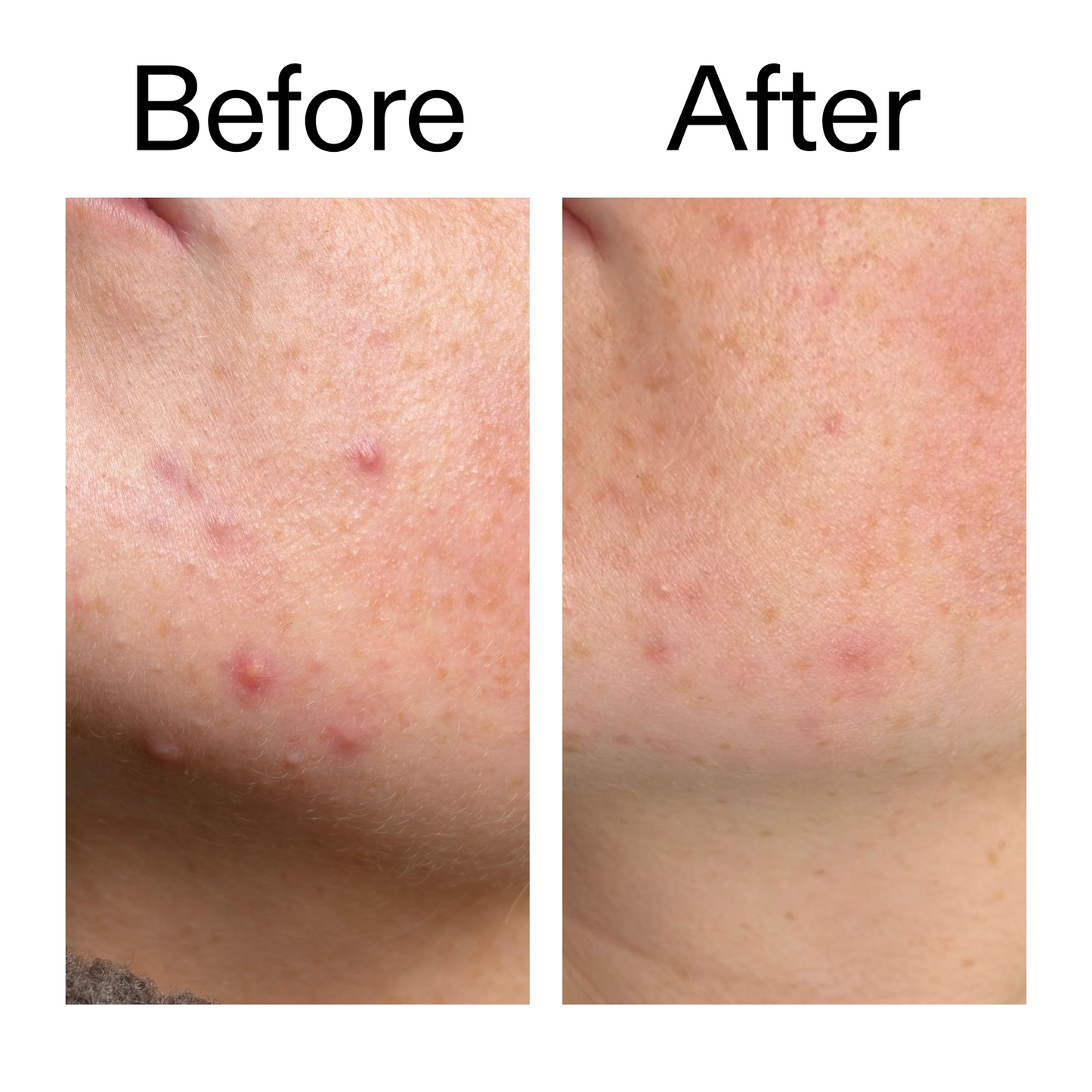 10-azelaic-acid-serum-for-redness-relief-w7 B_A_1_PPAGE.png