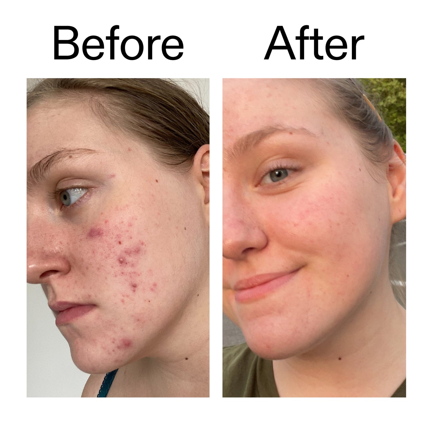 glycolic-acid-toner-q0 Glycolic_Acid_Toner_Before_After_2000x2000_49f0b9f7-e71b-4b2e-a8f8-2ea4b73247bb.jpg