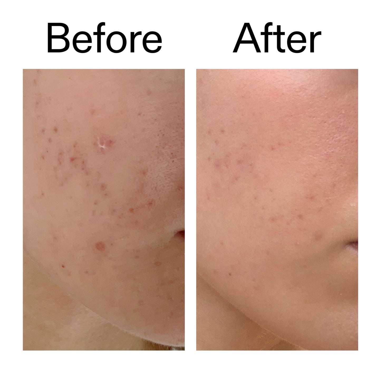 mandelic-acid-treatment-w2 Mandelic_Acid_Treatment_Before_After_2000x2000_4885ac6e-c5d7-4279-a72a-1417af7dce35.jpg