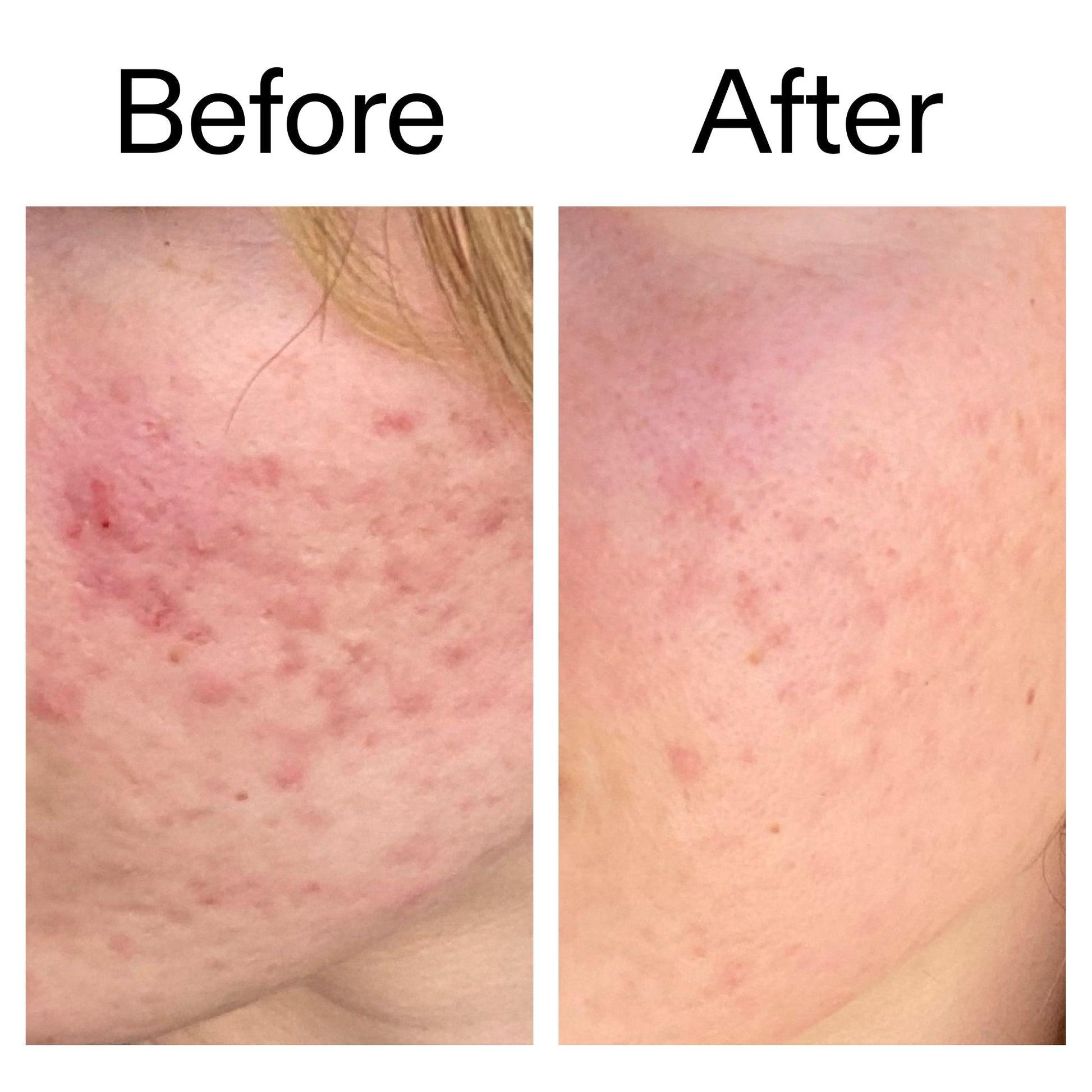 10-azelaic-acid-serum-for-redness-relief-w7 Azealic_Acid_Serum_B_A_Ppage_2000_x_2000.jpg