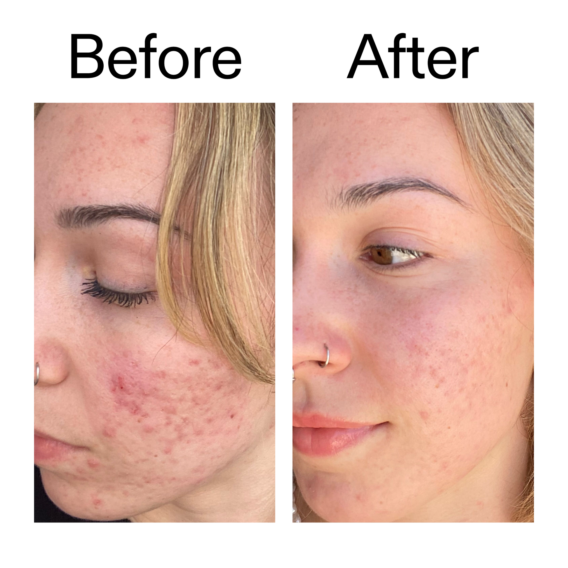 10-azelaic-acid-serum-for-redness-relief-w7 B_A_2_PPAGE.png