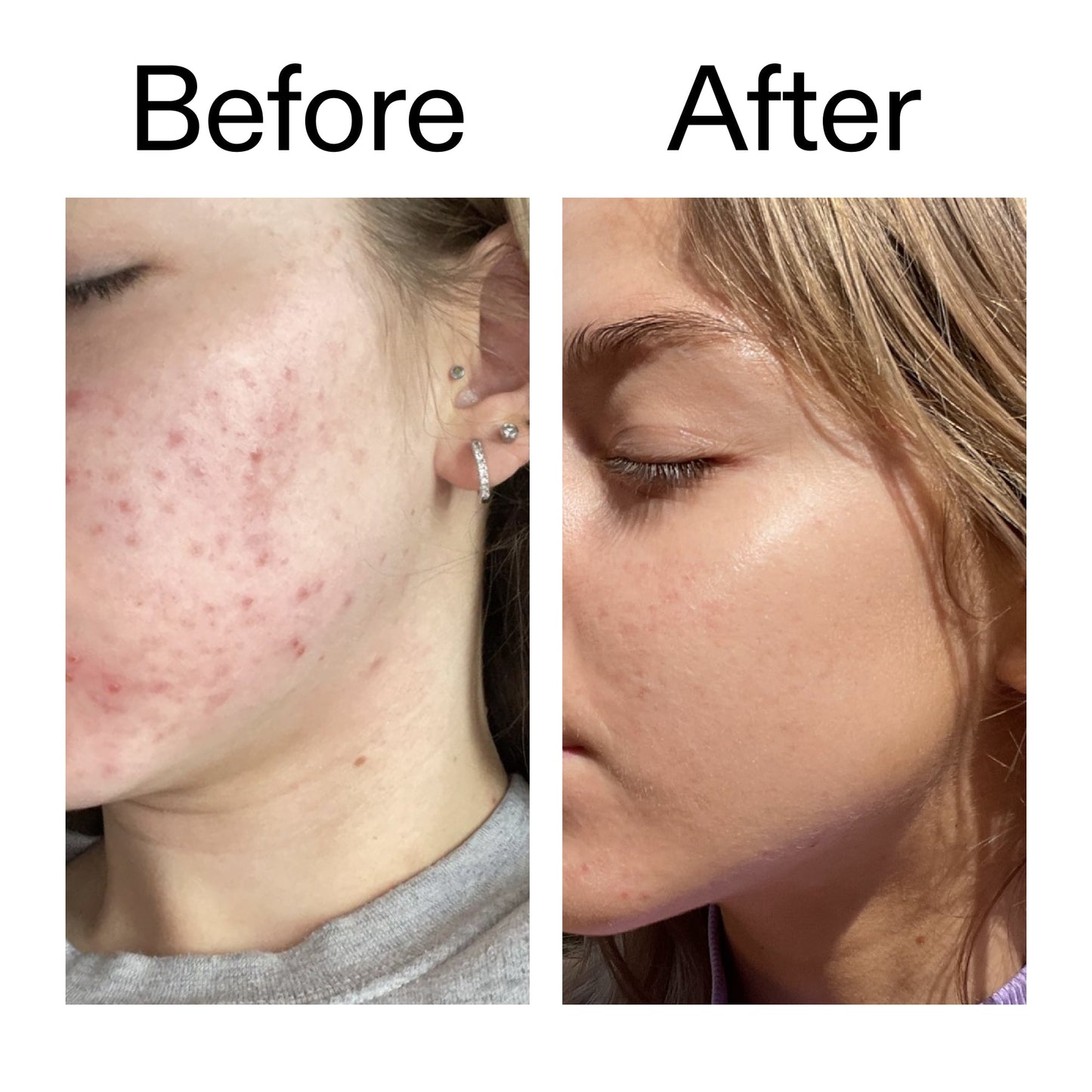 beta-hydroxy-acid-bha-serum-c0 Beta_Hydroxy_Acid_Serum_Before_After_2000x2000_96fda3e5-938d-49ef-bcf2-a0fa6ece4e2c.jpg