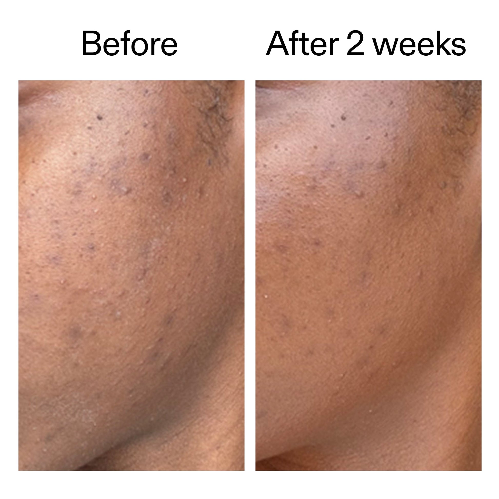 360-acne-clearing-duo-x8 DIOICB_A2000x2000.jpg