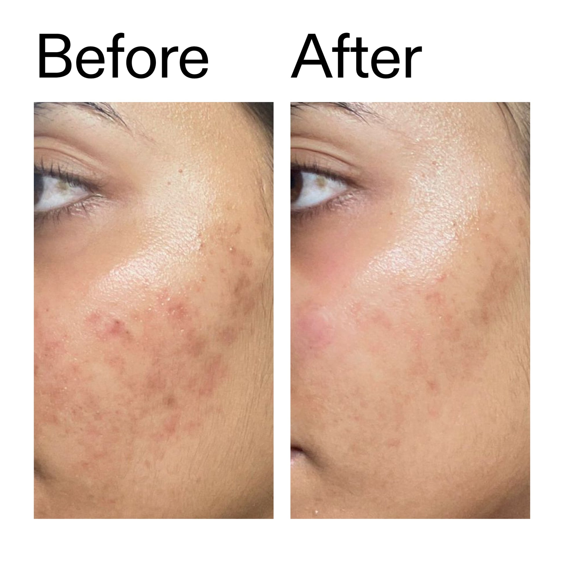 ectoin-hydro-barrier-serum-duo-e6 Ectoin_Hydro-barrier_Serum__Before_After_2000x2000_34261920-d004-48d0-9c7b-8e1c15971bfd.jpg