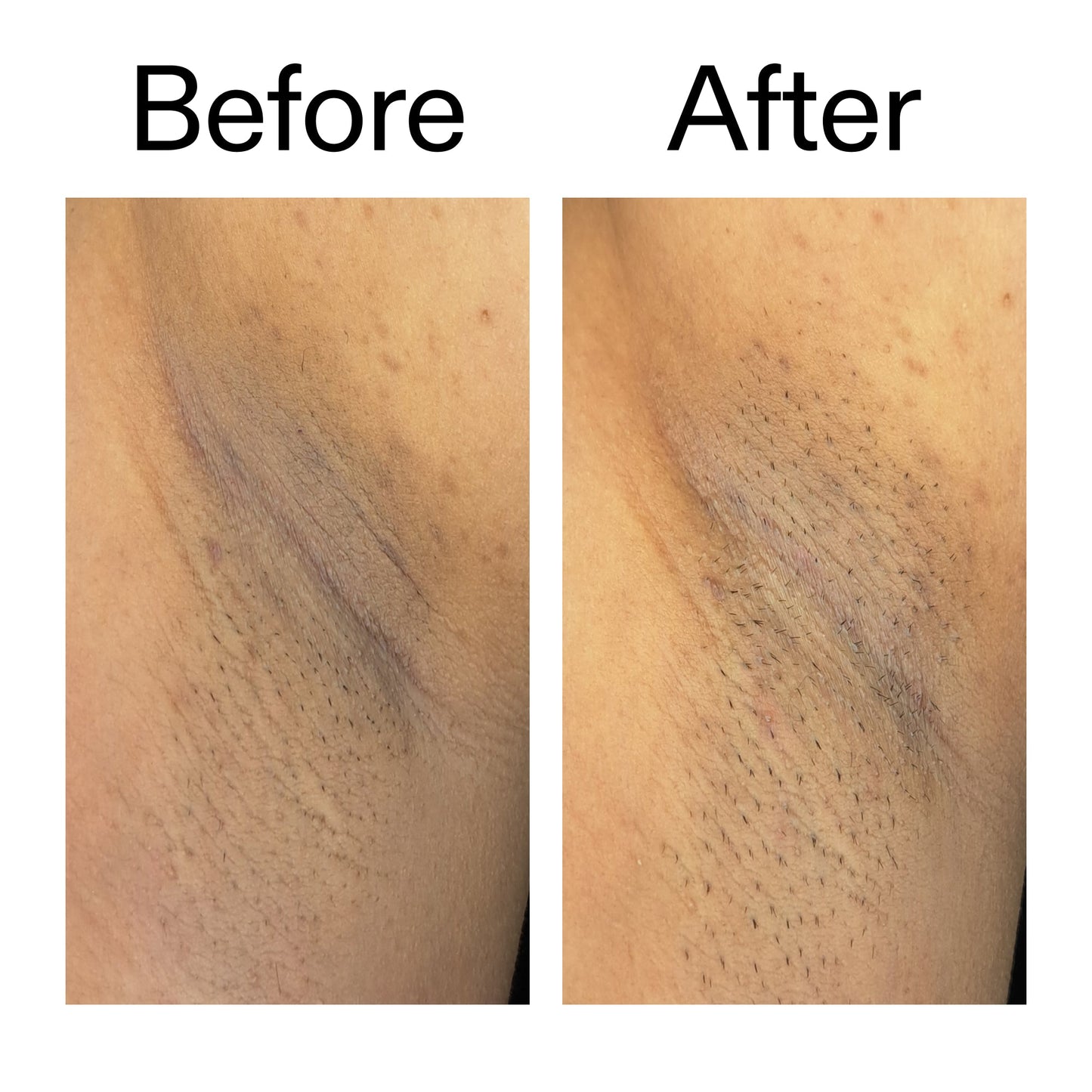 glycolic-acid-exfoliating-body-stick-duo-o5 Glycolic_Acid_Exfoliating_Body_Stick_Before_After_V3_2000x2000_ea919cd9-1439-4a46-82a0-76200eb5bb42.jpg
