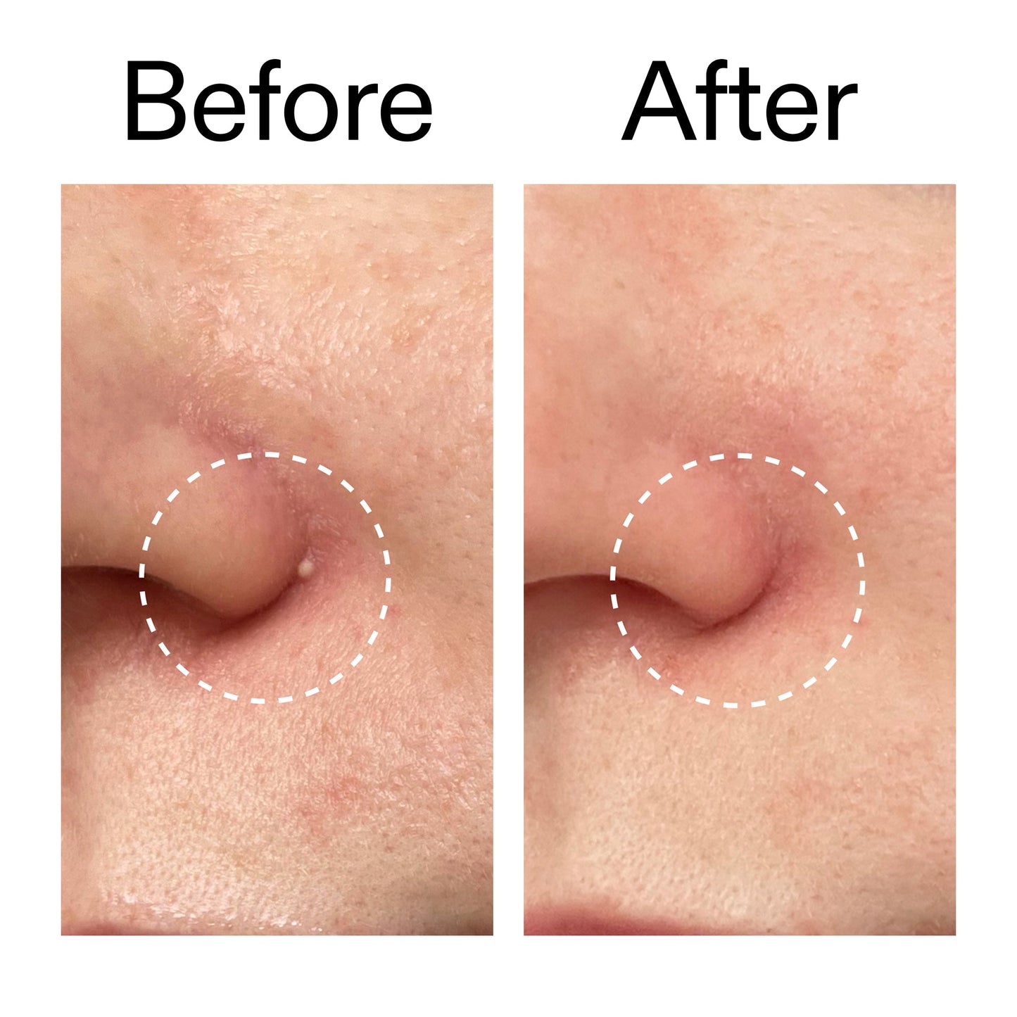 hydrocolloid-invisible-pimple-patches-pack-of-44-z0 Hydrocolloid_Invisible_Pimple_Patches_Before_After_2000x2000_b02aa37b-c78a-4682-91de-9135af5bb7df.jpg