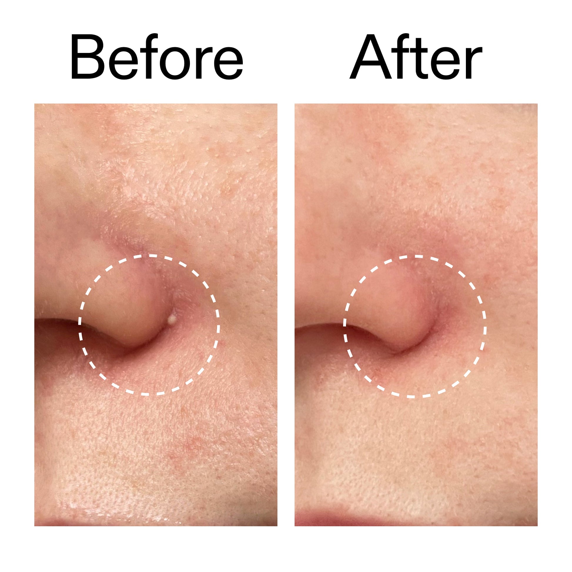 hydrocolloid-invisible-pimple-patches-pack-of-44-z0 Hydrocolloid_Invisible_Pimple_Patches_Before_After_2000x2000_b02aa37b-c78a-4682-91de-9135af5bb7df.jpg