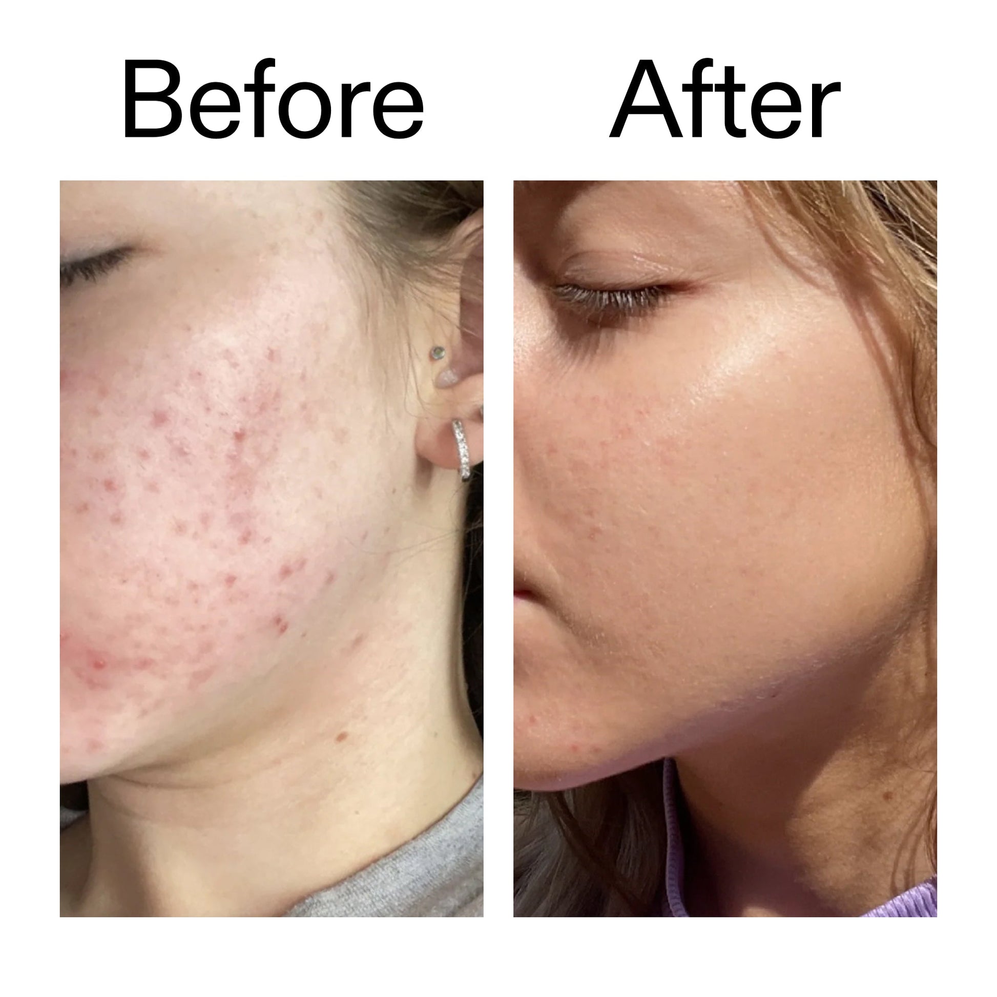 10-niacinamide-serum-duo-z4 Niacinamide_Serum_Before_After_2000x2000_bde32455-9e7d-448e-b053-bef41504f0a9.jpg