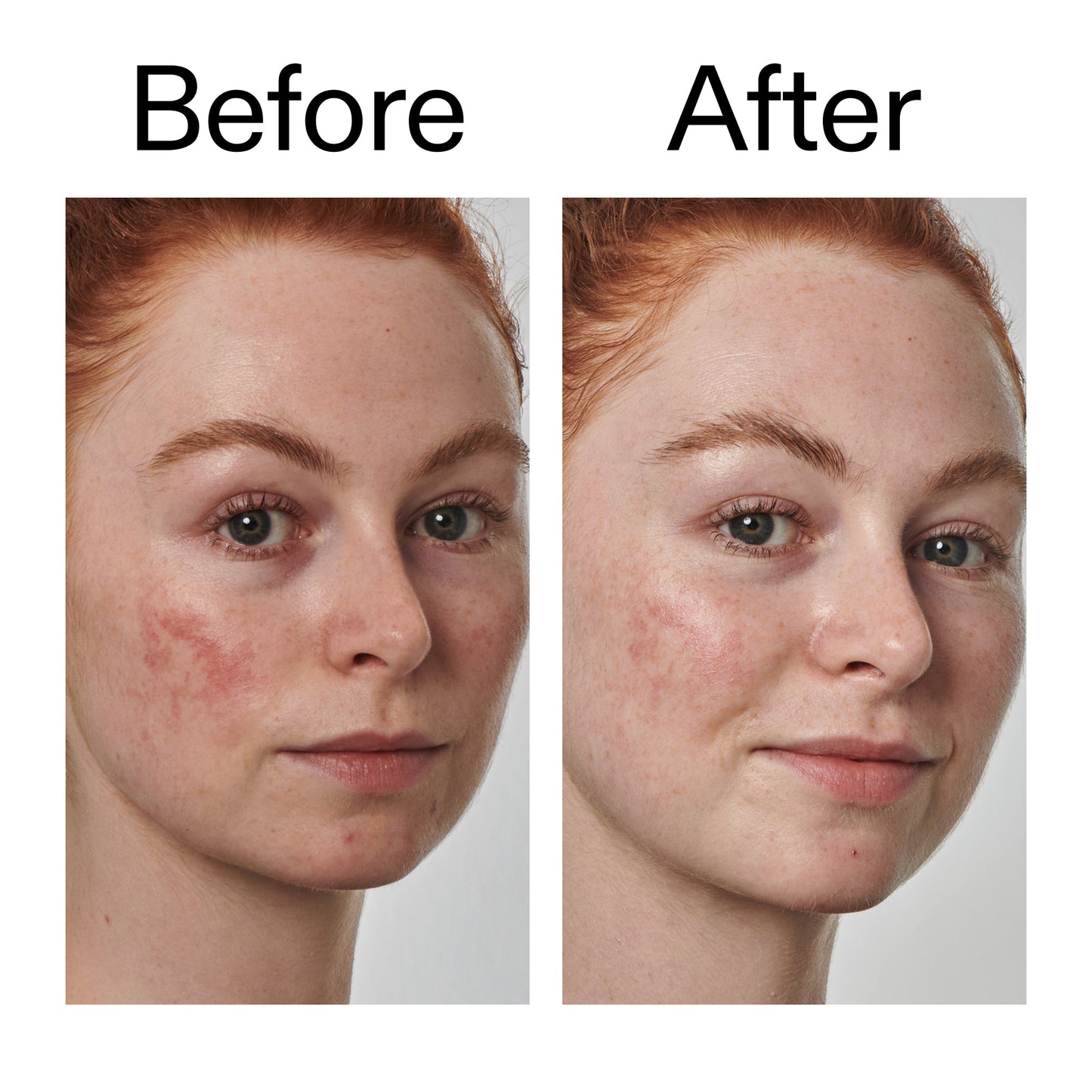 10-azelaic-acid-serum-for-redness-relief-w7 Redness_Relief_Serum_Before_After_2000x2000_3334dc9a-cce9-4e00-8aec-7ad89ca051f2.jpg