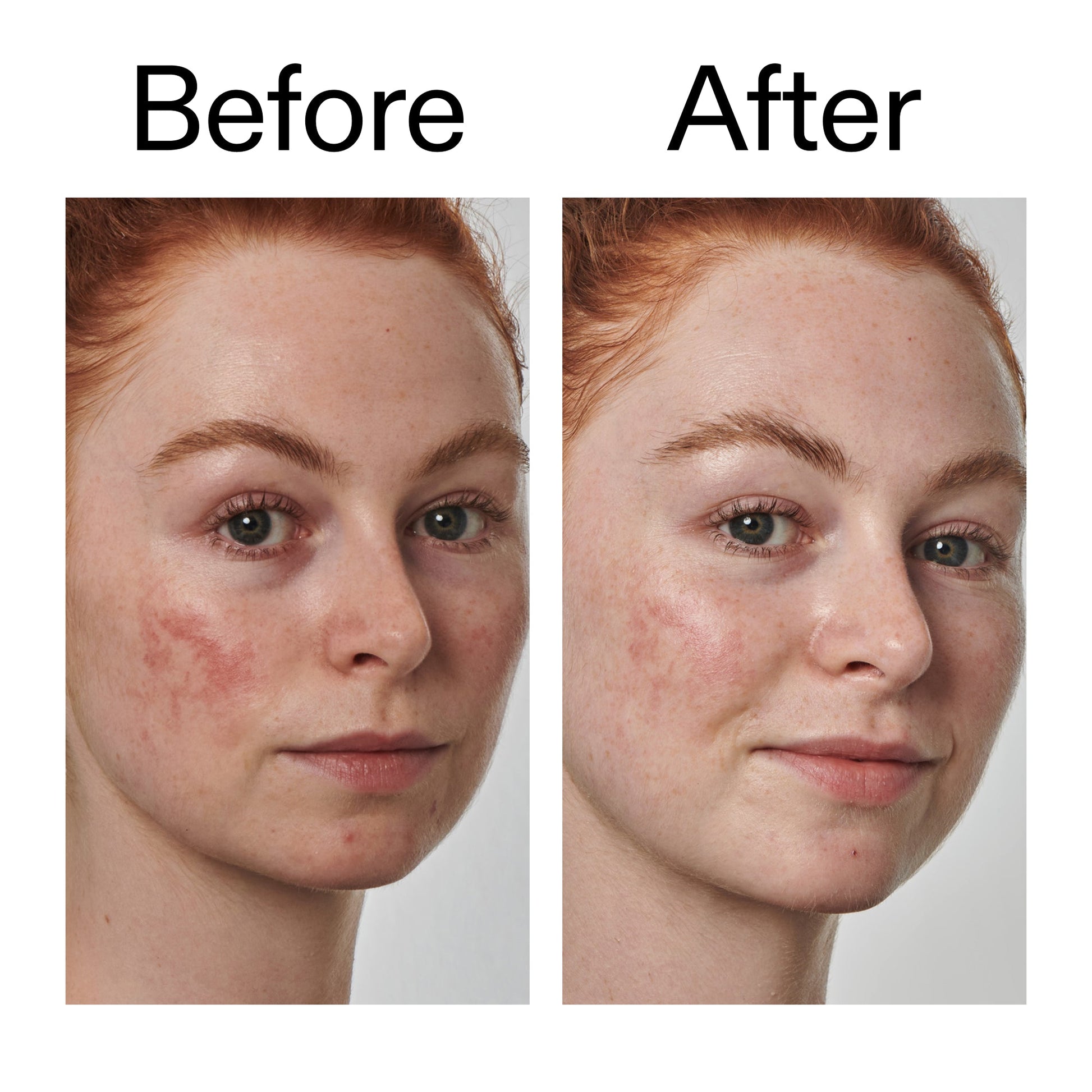 10-azelaic-acid-serum-for-redness-relief-w7 Redness_Relief_Serum_Before_After_2000x2000_3334dc9a-cce9-4e00-8aec-7ad89ca051f2.jpg