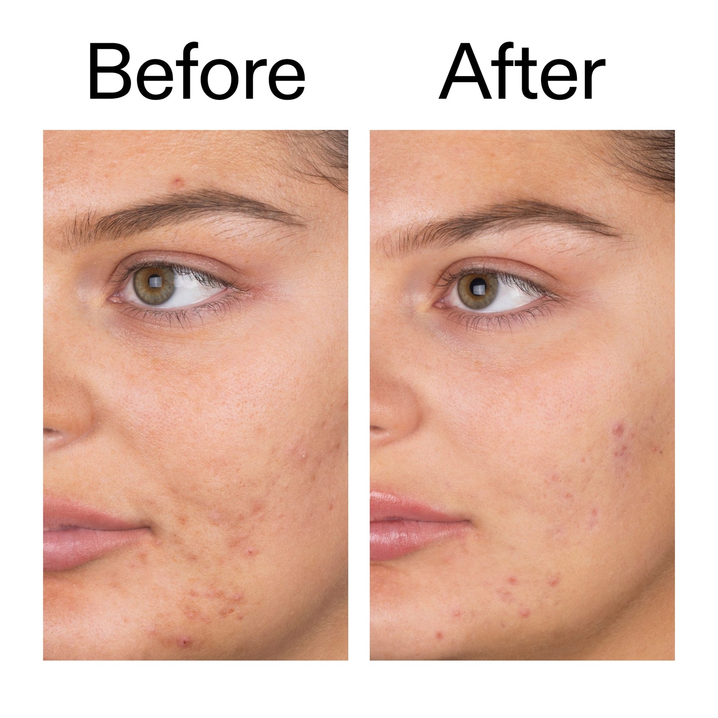 salicylic-acid-cleanser-150ml-j2 Salicylic_Acid_Cleanser_-_150ml_Before_After_2000x2000_e7230494-853f-4b07-82b1-27669104c995.jpg