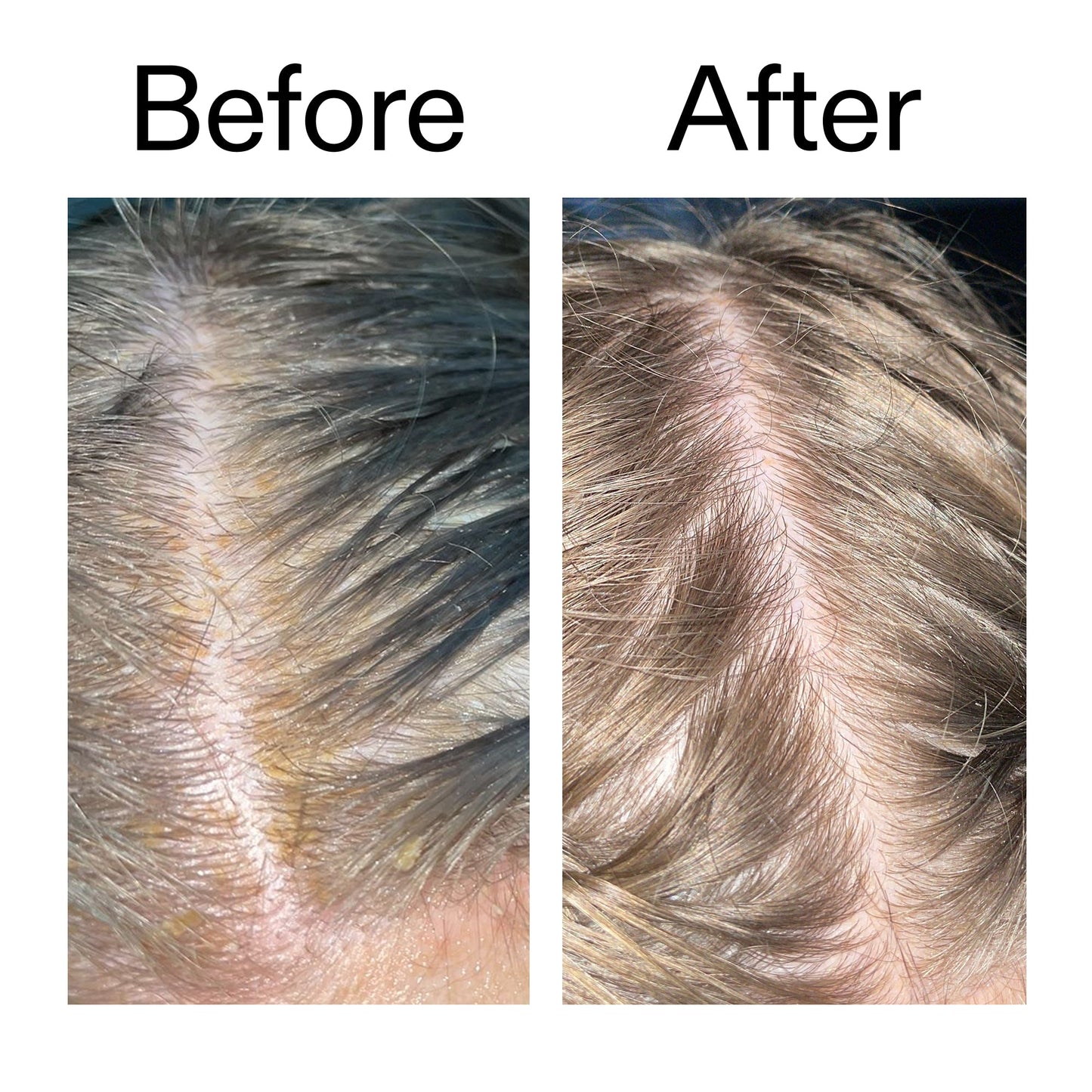 salicylic-acid-exfoliating-scalp-treatment-h7 Salicylic_Acid_Exfoliating_Scalp_Treatment_Before_After_2000x2000_e572a30f-057c-4a48-823b-1c09dc97f8d0.jpg