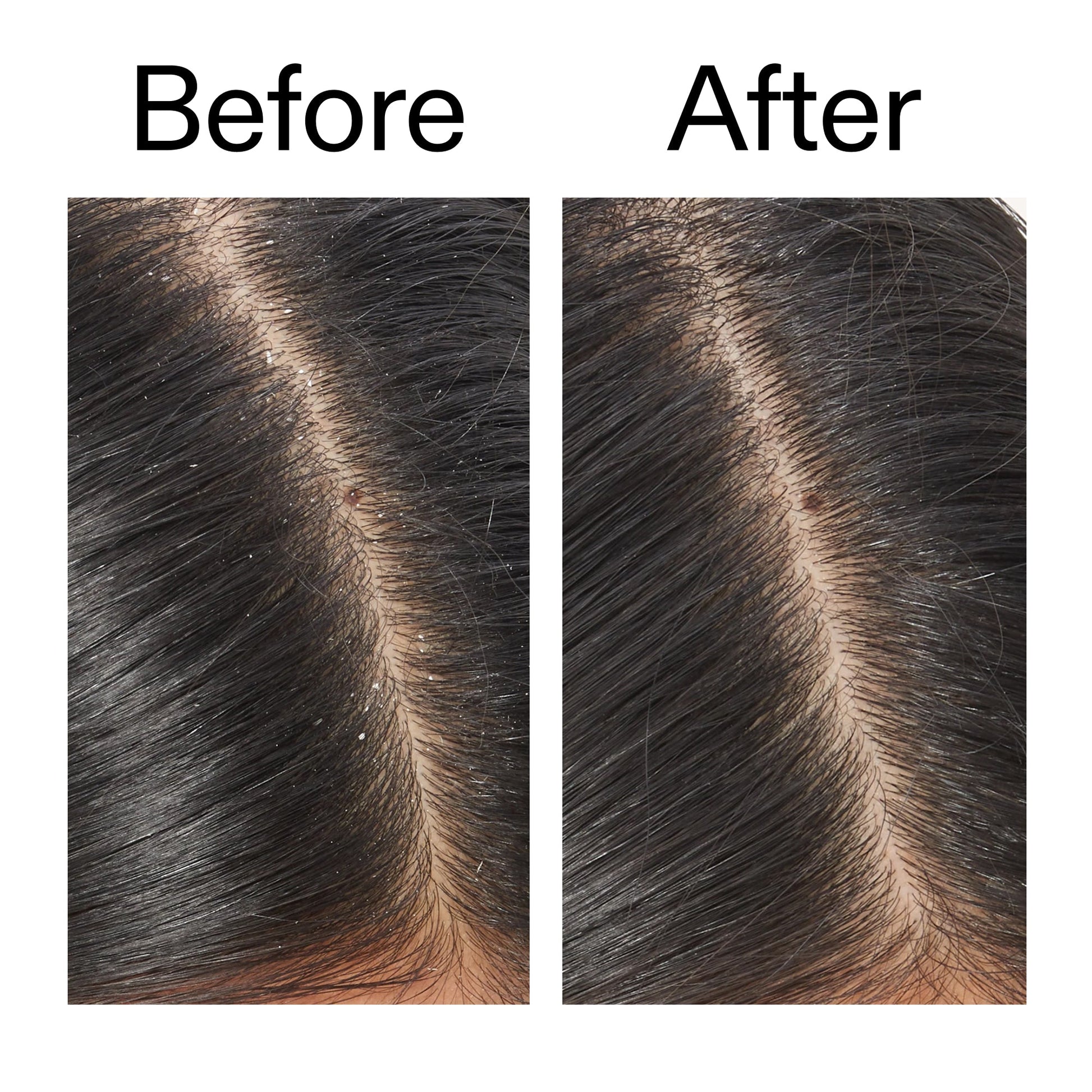 salicylic-acid-exfoliating-scalp-treatment-h7 Salicylic_Acid_Exfoliating_Scalp_Treatment_Before_After_V2_2000x2000_02bd61ad-42bf-490b-b3e3-7e04b2e8a673.jpg