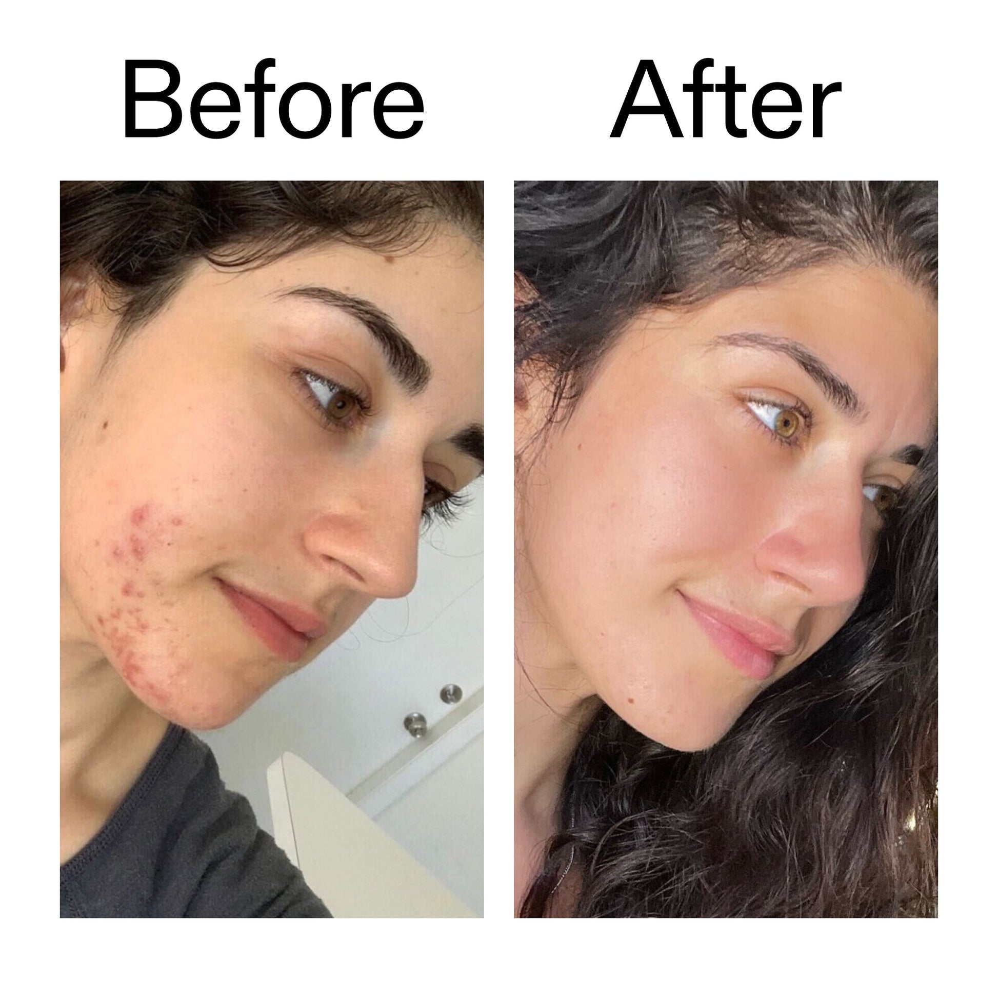 succinic-acid-acne-treatment-q6 Succinic_Acid_Treatment_Before_After_2000x2000_6a5f0054-2f58-4433-9314-0dc72c9bdd3b.jpg