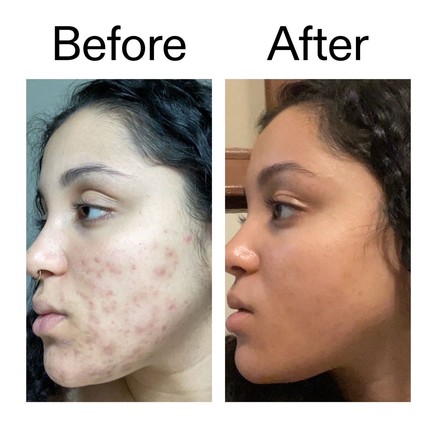 tranexamic-acid-serum-v1 Tranexamic_Acid_Serum_Before_After_2000x2000_98ebc8be-77b0-4843-8a22-90790ebe918b.jpg